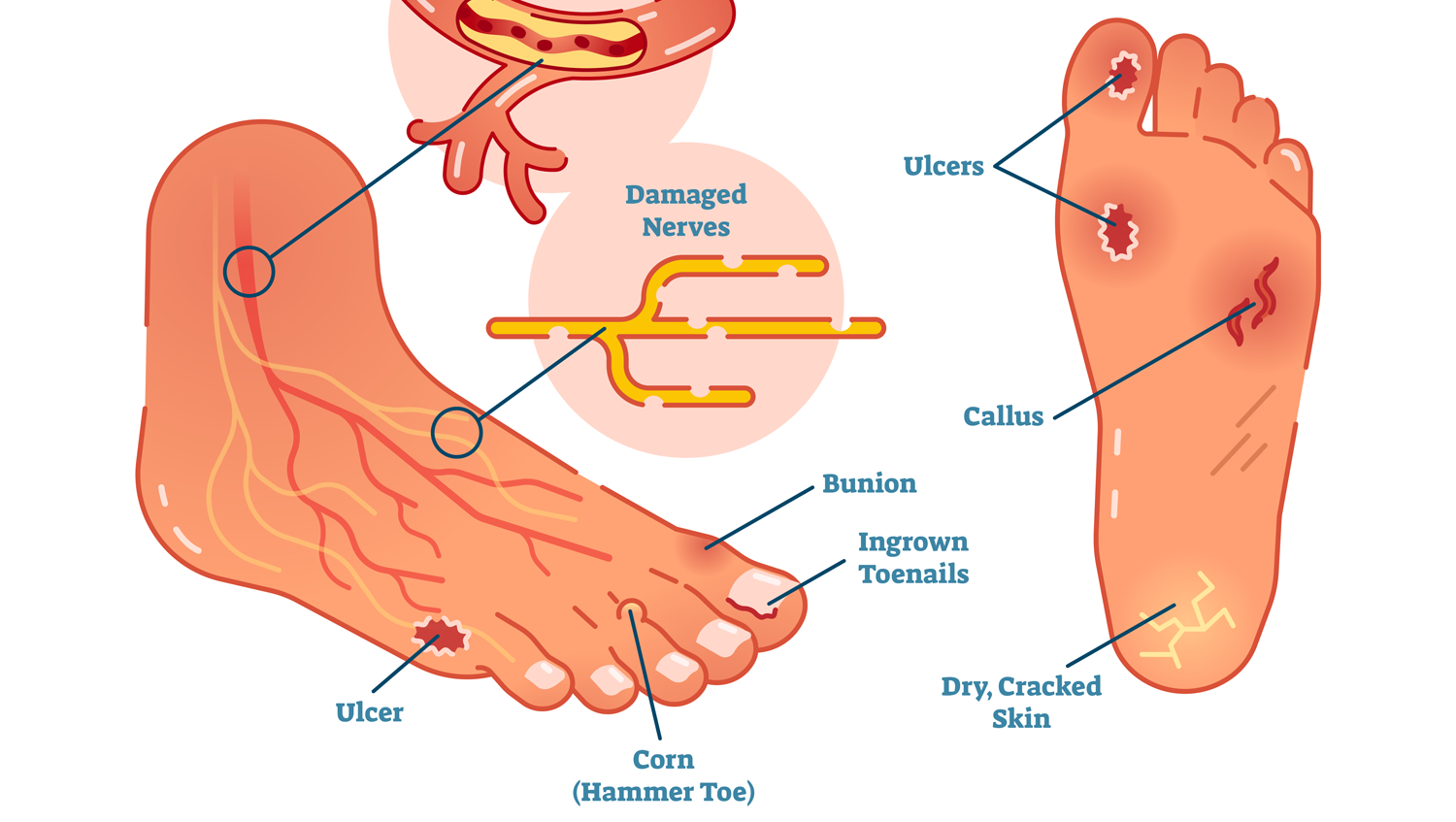 Diabetic Foot Health 